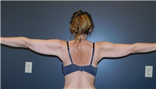Arm Lift Before Photo by Michele DeVito, MD, FACS; Scottsdale, AZ - Case 49665