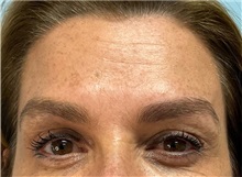 Botulinum Toxin After Photo by Julia Spears, MD, FACS; ,  - Case 49818