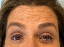 Botulinum Toxin Before Photo by Julia Spears, MD, FACS; ,  - Case 49818