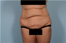 Tummy Tuck Before Photo by Ellen Janetzke, MD; ,  - Case 49829