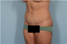 Tummy Tuck After Photo by Ellen Janetzke, MD; ,  - Case 49829